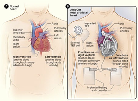 正常心脏（左）和植入式全人工心脏（右）示意图