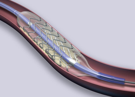 心脏支架有哪些你不知道的秘密?